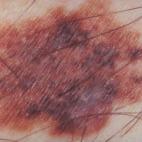 In situ melanomas Very early melanomas are