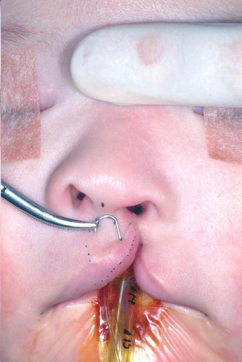 philtral column (Fig. 2). The rotation incision line of the medial lip was drawn in the curve connecting cphl and cphs, horizontal from the columellar-labial junction.