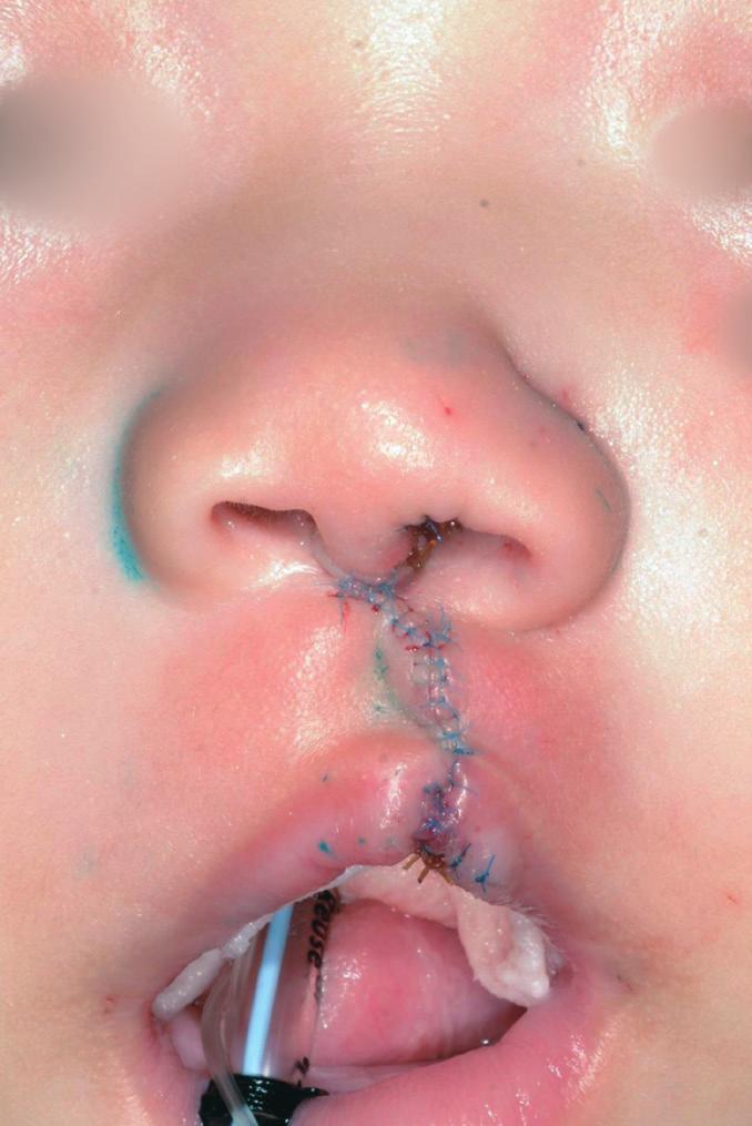 Kihwan Han et al. Repair of complete unilateral cleft lip A Analysis of surgical outcomes All patients were assessed using the scoring system proposed by Asher-McDade et al.