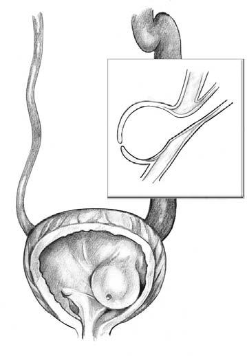 Bladder outlet obstruction (BOO). BOO describes any blockage in the urethra or at the opening of the bladder.