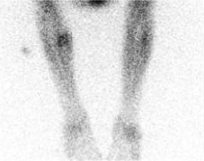 140 H. Otsuk, et l. Thllium-201 chloride scintigrphy in soft tissue tumors c d e Figure 4 Schwnnom in the left forerm.
