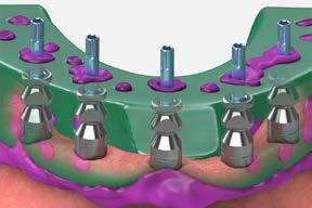 2 Place the abutments Remove the healing abutments using an.050 (1.25mm) hex driver.