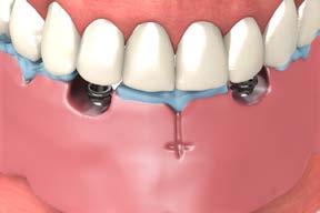 5 Lab step - Create a wax occlusal rim Create a wax occlusal rim on the stabilized baseplate allowing access to the screws.