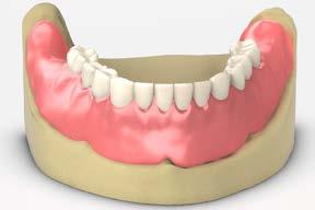 17 Try in the trial denture Place the trial denture on the bar and verify occlusion, esthetics, and phonetics. Make any necessary adjustments and take a new bite registration if needed.