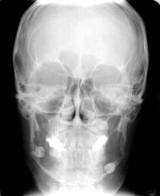 Dentigerous cysts are frequently discovered when radiographs are taken to investigate failure of tooth eruption, a missing tooth or cause for misalignment.