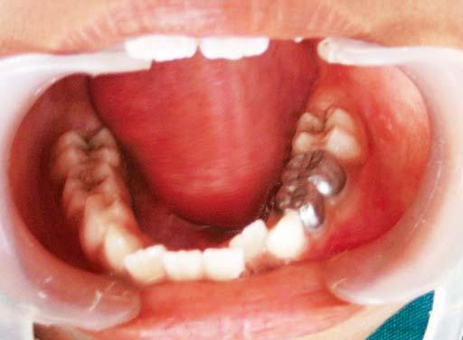 JOFR Dentigerous Cyst in Children: A Case Report and Outline of Clinical Management for Pediatric and General Dentists mouth.