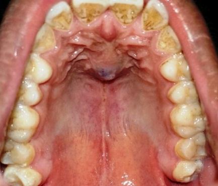 World Journal of Pharmaceutical Medical Research of rugal about 2 cm from the gingival margins bilaterally. No surface discharge or ulceration was seen. The surface had a bluish white tinge.