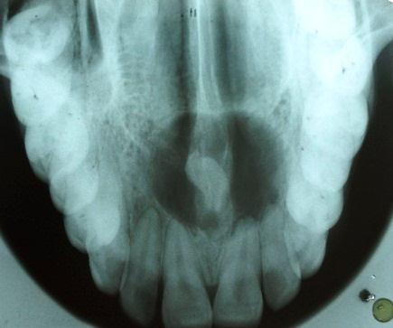 Radiological investigations included Intra Oral Periapical (IOPA), Occlusal, Ortho PentamoGraph (OPG).