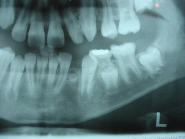 Iranian Journal of Orthodontics Shirani, Arshad, Asefi 45 found on the image with radiolucent rim around it that was formed in mesial of permanent mandibular left canine (Figure 2).
