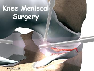 Introduction The meniscus is very important to the long-term health of the knee. In the past, surgeons would simply take out part or all of an injured meniscus.