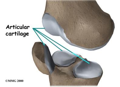 The menisci (plural for meniscus) protect the articular cartilage on the surfaces of the thighbone (femur) and the shinbone (tibia).