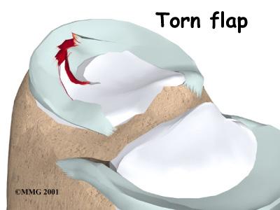 The flap may be getting caught in the knee joint as you bend it. Or a small piece of the meniscus could actually be floating around inside the joint.
