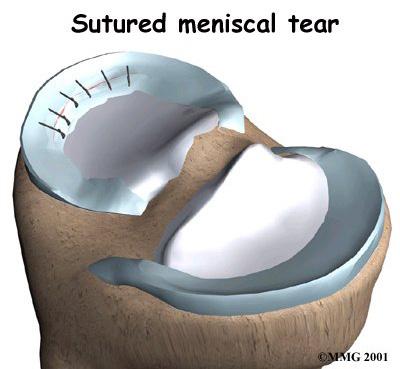 Suture Anchor Repair Meniscal Repair Suture Repair Using the arthroscope and a probe, the surgeon locates the tear. The probe is used to push the torn edges of the meniscus together.
