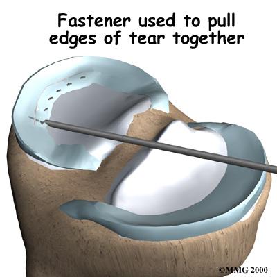 The surgeon threads a suture through the cannula and into the knee joint. The suture is sewn into the two edges of the tear. The surgeon tugs on the thread to bring the torn edges close together.