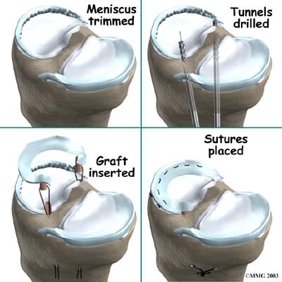 Meniscal Transplantation If the meniscus cannot be repaired or has been previously removed, a new form of treatment may offer a way to slow the onset of knee arthritis.