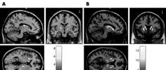 of the Huntington's disease patient subgroups v age matched controls: panels A and B for the criterion motor deficits;