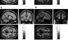 All regions are shown where the corresponding subgroup (n = 12 each) had a significantly decreased grey matter density