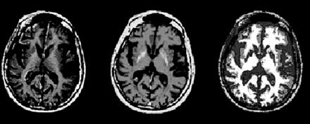 subjects Aylward EH et al. Neurology 2004;63:66-72 Figure 2.