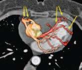 Breast Cancer Therapy LAD and left circumflex Artery Right coronary artery *Arrows point to subsections of the