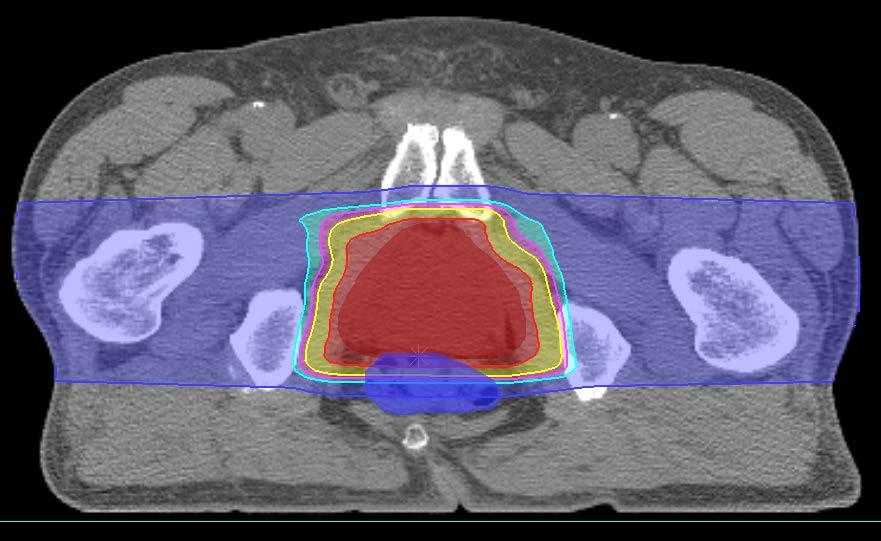 Direct Radiation Complications Never Occur in Unirradiated Tissues 1 IMRT immerses more healthy tissue with radiation IMRT 7-field co-planer Radiation therapy plans for prostate cancer Proton therapy