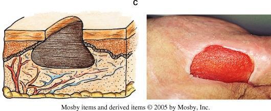 Classification of Pressure Ulcers Stage III: full-thickness skin loss