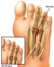 Branches Union of lateral and medial plantar nerves to form the common plantar digital nerve Fixed System Common peroneal nerve at head of