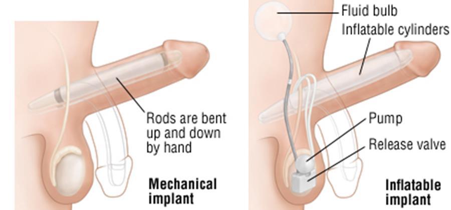 Penile Prosthesis ( surgery)
