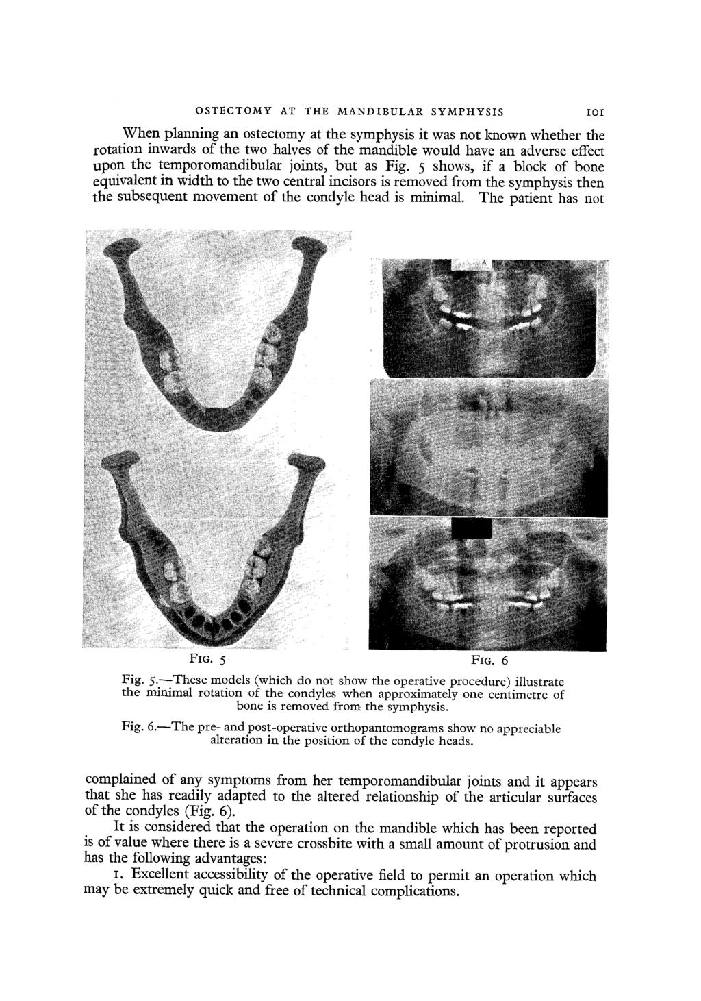 OSTECTOMY AT THE MANDIBULAR SYMPHYSIS When planning an ostectomy at the symphysis it was not known whether the rotation inwards of the two halves of the mandible would have an adverse effect upon the