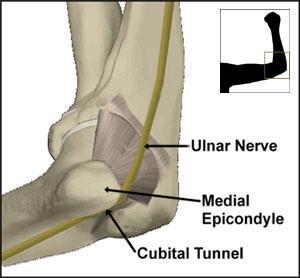 Ulnar Neuropathy at the Elbow (UNE) a) Ulnar Groove (located just proximal to medial epicondyle) b) Cubital Tunnel Syndrome (bordered by medial epicondyle, olecranon and overlying FCU aponeurosis) ~
