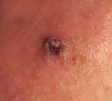 Skin cancer can be divided into two main groups; Non-Melanoma Skin Cancer (NMSC) & Malignant Melanoma (MM).