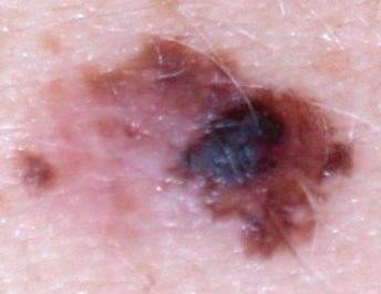 THE ABCDE OF MELANOMA RULE: A = ASYMMETRY: when one half of the mole