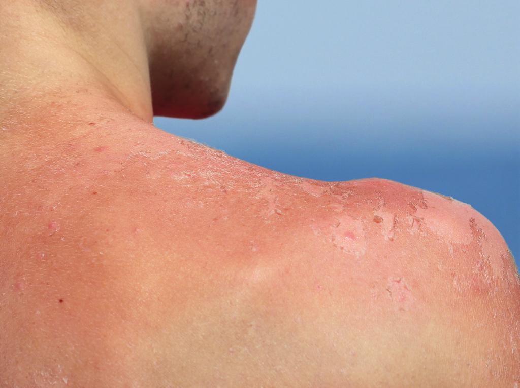 The simple fact is that if you fail to protect your skin from UV radiation you re putting yourself at risk. If you allow your skin to become red and burn, this risk can dramatically increase.