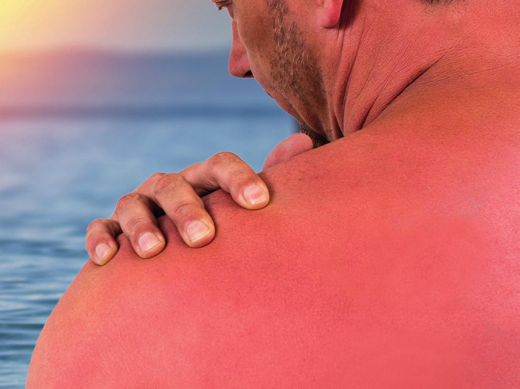 SUN BURN THE FACTS THE SIMPLE FACT THAT YOUR SKIN HAS CHANGED COLOUR IS A SIGN OF DAMAGE. OUR SKIN TURNS RED WITHIN 2-6 HOURS OF BEING BURNT AND CONTINUES TO DEVELOP FOR THE NEXT 24 TO 72 HOURS.