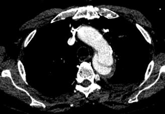 CHEST CT #3 ONE DAY AFTER CT #2 Conversion of IMH into