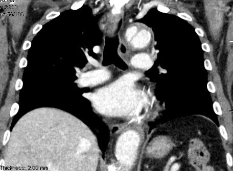 CHEST CT #3 ONE DAY AFTER CT #2 Conversion of IMH into aortic dissection NYU Leon H.
