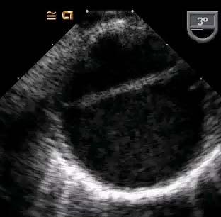ACUTE AORTIC SYNDROME ON TEE CLASSIC AORTIC