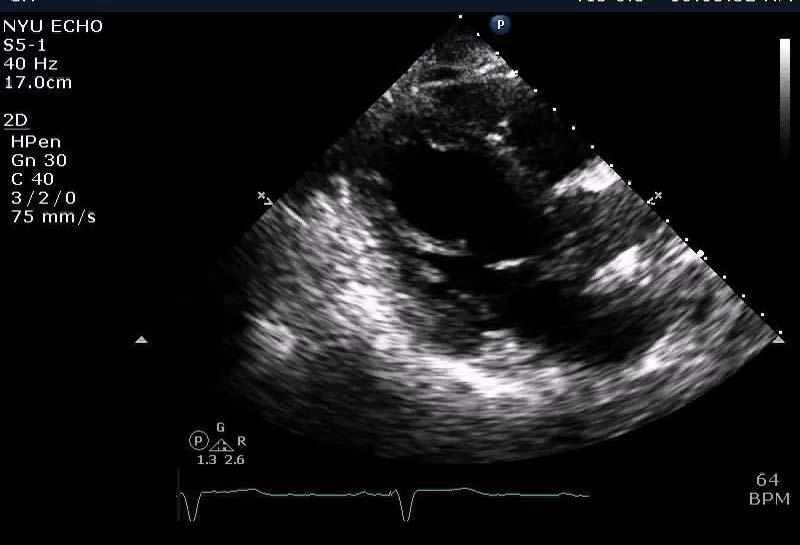 CASE PRESENTATION 80-year-old man presents with severe headache and nonexertional chest pain in the setting of severe hypertension (BP 210/90 mm Hg) PAST