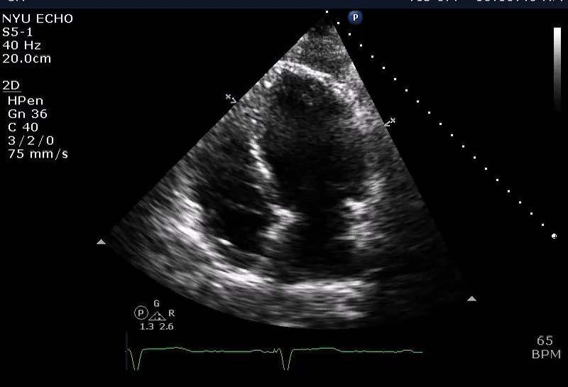 aneurysm Bradycardia (s/p Permanent pacemaker placement) Transthoracic echocardiogram was ordered NYU Leon H.