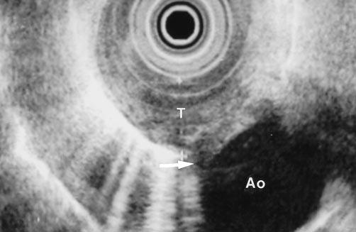 arrow) (T = tumor, Ao = aorta.