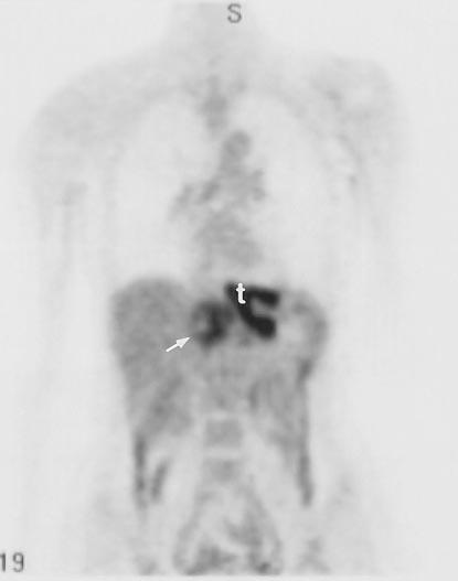 Diagnosis and Preoperative Staging of Esophageal Cancer 43 Positron emission tomography identified 51 metastases in 27 of the 39 cases, demonstrating a sensitivity of 69 percent, a specificity of 93.