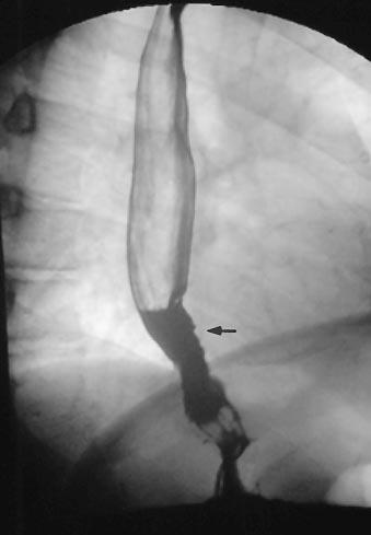 B, Barium swallow demonstrates a distal esophageal tumor above a hiatal hernia (arrows).