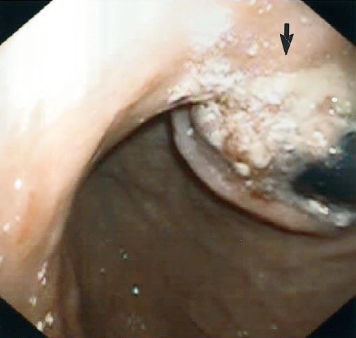 Diagnosis and Preoperative Staging of Esophageal Cancer 29 malignant condition of Barrett s esophagus.
