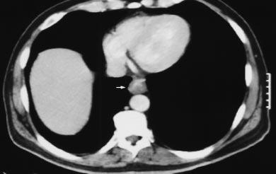 Computed tomography of esophageal masses and metastatic