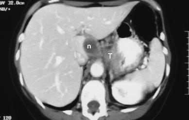 B, A small distal esophageal tumor (arrow).