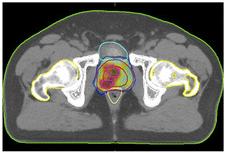 4 MR-guided radiation therapy Dynamic MRI images