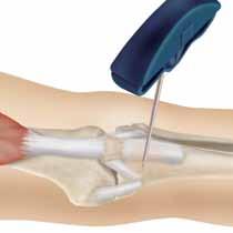Distal Tibia Using the ported 11G aspiration needle from the mini IGNITE Power Mix kit, insert the needle into the medial face of the tibia at the distal metaphysis.