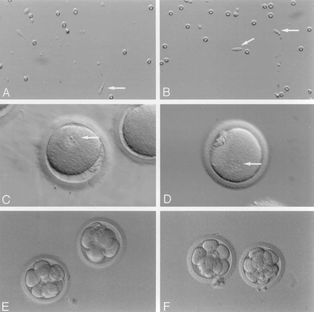 FIGURE 1 Selection of testicular sperm and elongated spermatids (A, B) and after injection into metaphase arrested rhesus oocytes (C F).