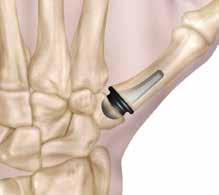If between 10-30, pinning or capsulodesis may decrease subluxation potential and increase thumb pinch function.