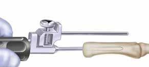 3-1 3-2 Mount the external Alignment Guide on the Alignment Awl, insert the Alignment Awl into the shaft of the metacarpal.