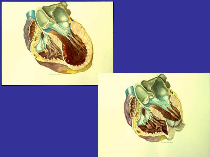 Surgical Ventricular Reconstruction STICH Trial